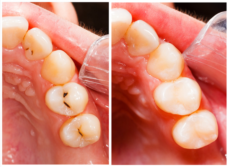 Fillings  San Diego, CA , 