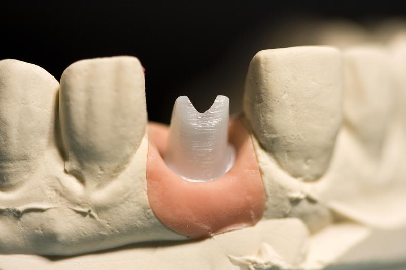 Implant Restoration  San Diego, CA , 